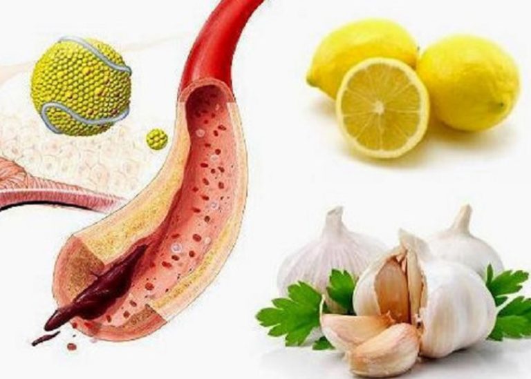 Какие продукты на самом деле забивают сосуды