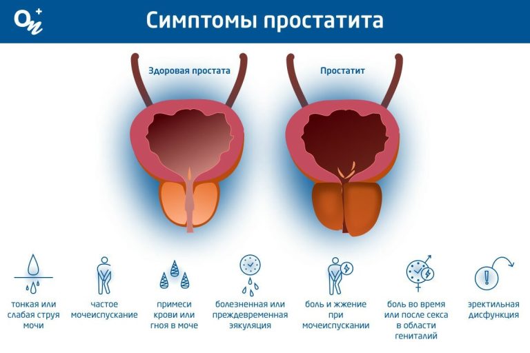 Симптоми простатиту: як розпізнати і не пропустити