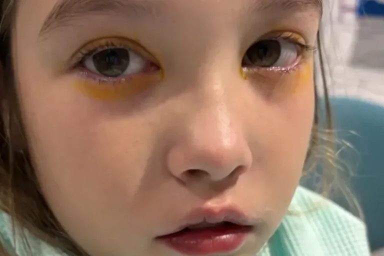 YouTube-лайфгак ледь не позбавив зору 10-річну дівчинку з Уельсу